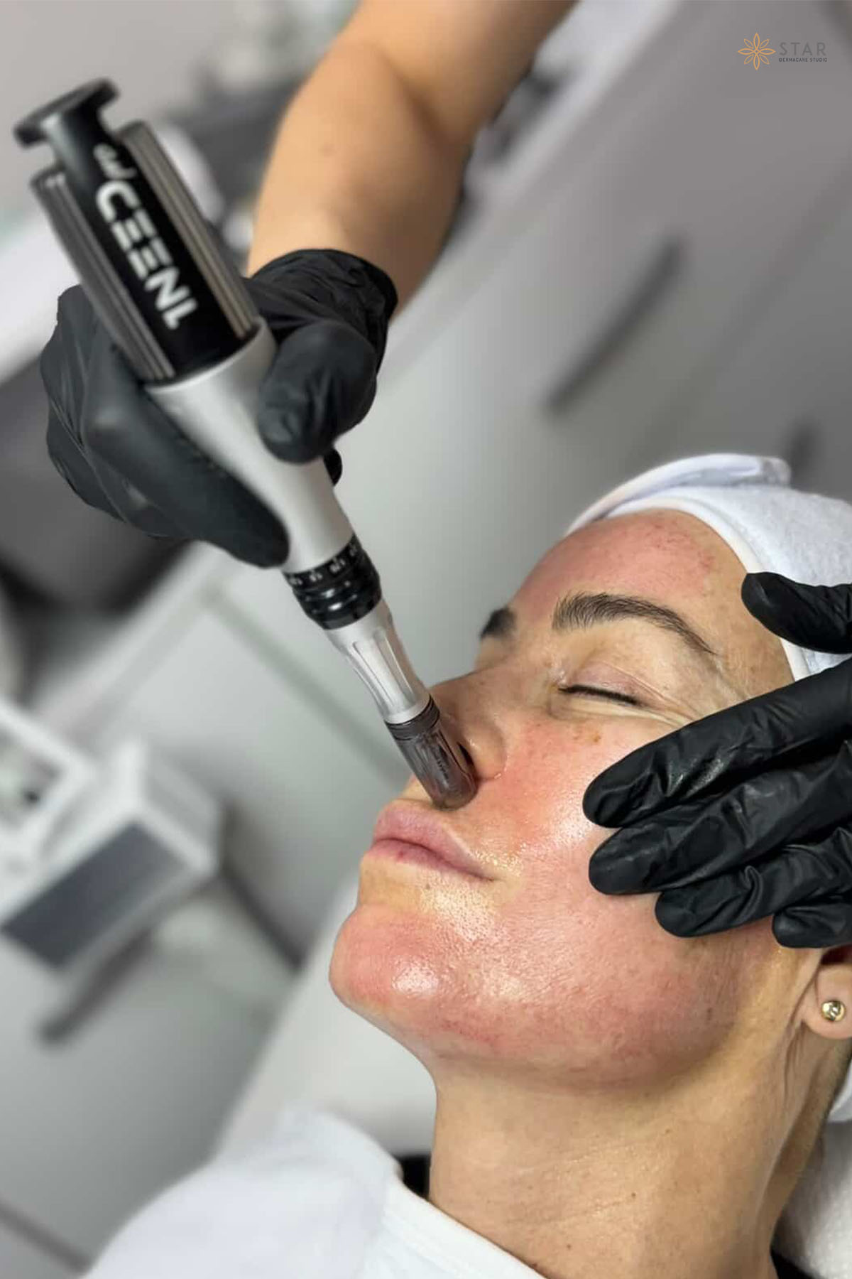 Dermapen 1NEED Pro Tretman